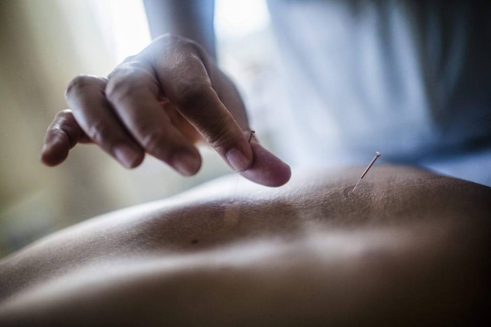 Hand holding a fine acupuncture needle over a patient