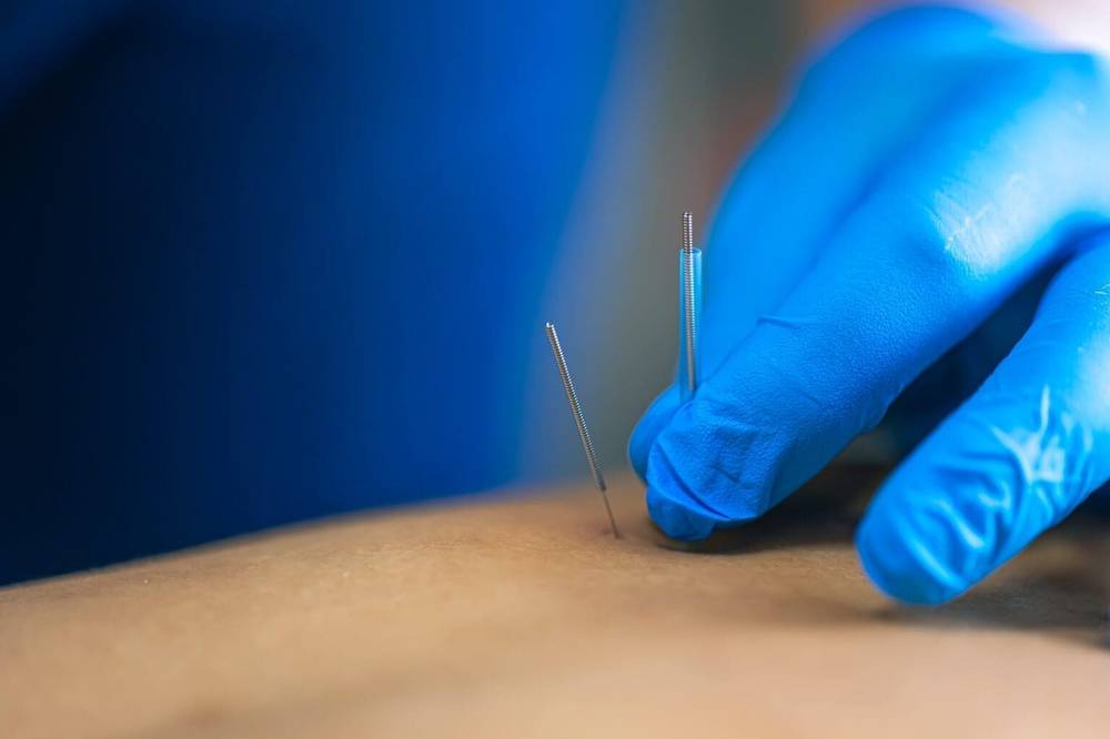 Practitioner performing dry needling on a patient