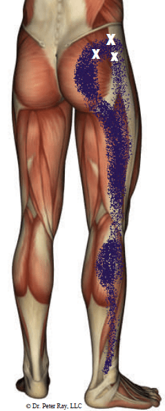 Diagram of trigger points in a muscle and the areas where they refer pain