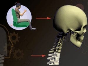 Diagram of the head and torso thrown forward 200 milliseconds after impact