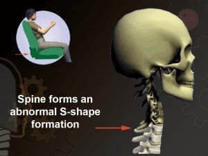 Diagram of the lower neck bending into an S shape 75 milliseconds after impact